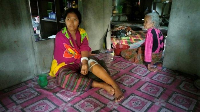 Indo Efo mendapatkan 32 jahitan pada dua luka di kaki dan tangan kiri karena digigit buaya.