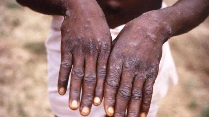 Inilah Gejala dan Cara Mencegah Penularan Cacar Monyet, Virus yang Sedang Menghebohkan Singapura