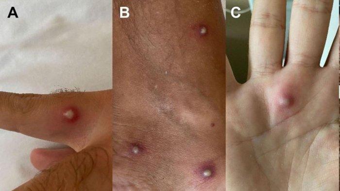 Bintik-bintik besar di tubuh seorang pria yang menderita cacar monyet